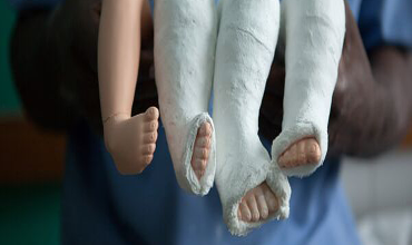 Лечение косолапости у новорожденных детей Косолапость у детей