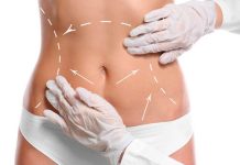 Липосакция живота