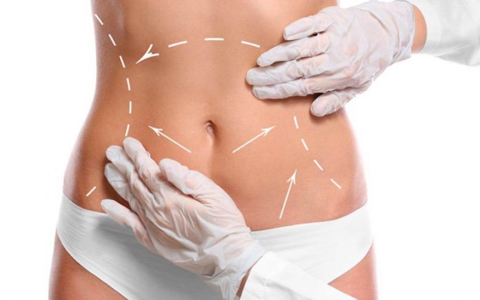 Липосакция живота
