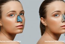Ринопластика: нацеленность только на успех