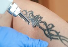 Удаление тату: подробнее о вариантах