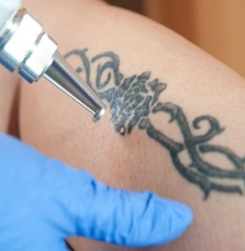 Удаление тату: подробнее о вариантах