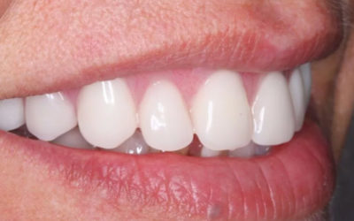 К вопросу о винирах