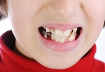 Кариес. Почему он возникает?