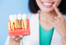 Зубная имплантация под ключ: что учесть