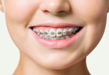 Преимущества брекетов: красивая и здоровая улыбка