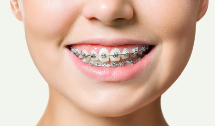 Преимущества брекетов: красивая и здоровая улыбка