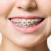 Преимущества брекетов: красивая и здоровая улыбка