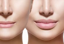 Увеличение губ гиалуроновой кислотой: подчеркните вашу естественную красоту