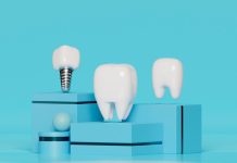 Имплантация зубов 4D: Все, что вам нужно знать