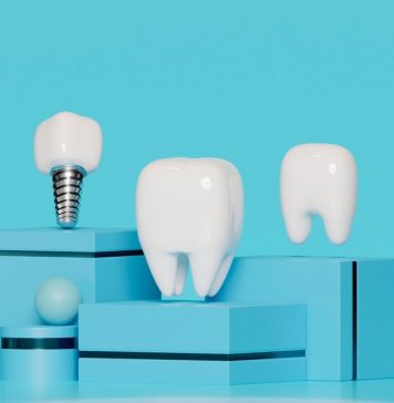 Имплантация зубов 4D: Все, что вам нужно знать