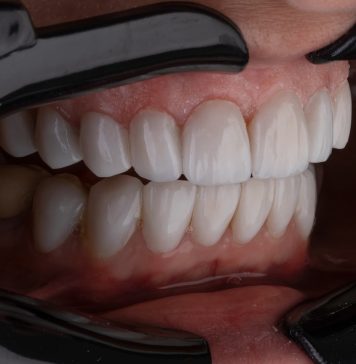 Лечение зубов: как сохранить свою улыбку на долгие годы