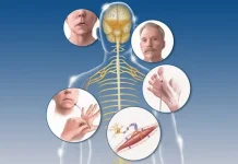 Что такое рассеянный склероз: понимание заболевания и современные взгляды на жизнь с ним