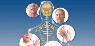 Что такое рассеянный склероз: понимание заболевания и современные взгляды на жизнь с ним